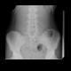 Osteopathia striata, systemic bone disorder: X-ray - Plain radiograph